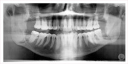 Dental Exams & Xrays - Mountain Dental